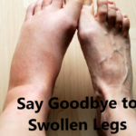 Say Goodbye to Swollen Legs: The Real Cause and Simple Solutions